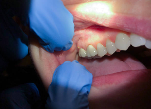 Best Dental Abscess Treatment in Hempstead, TX